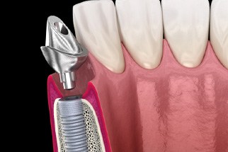 A 3D illustration of a dental implant abutment