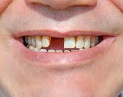 Smile with one missing tooth