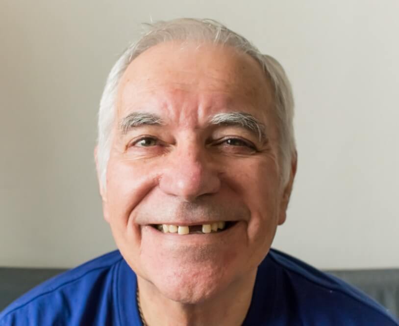 Man smiling with missing front tooth