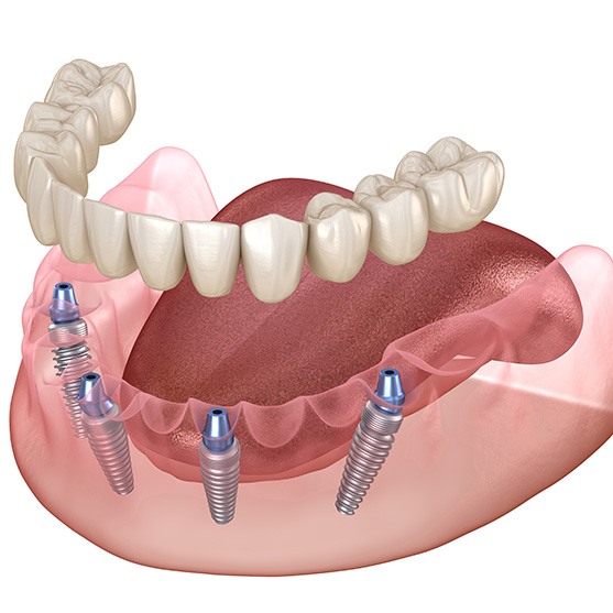 Digital illustration of All-on-4 dental implants