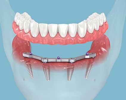 Illustration of 4 dental implants holding a full set of lower dentures with light blue background