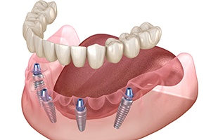 Illustration of dentures being attached to dental implants