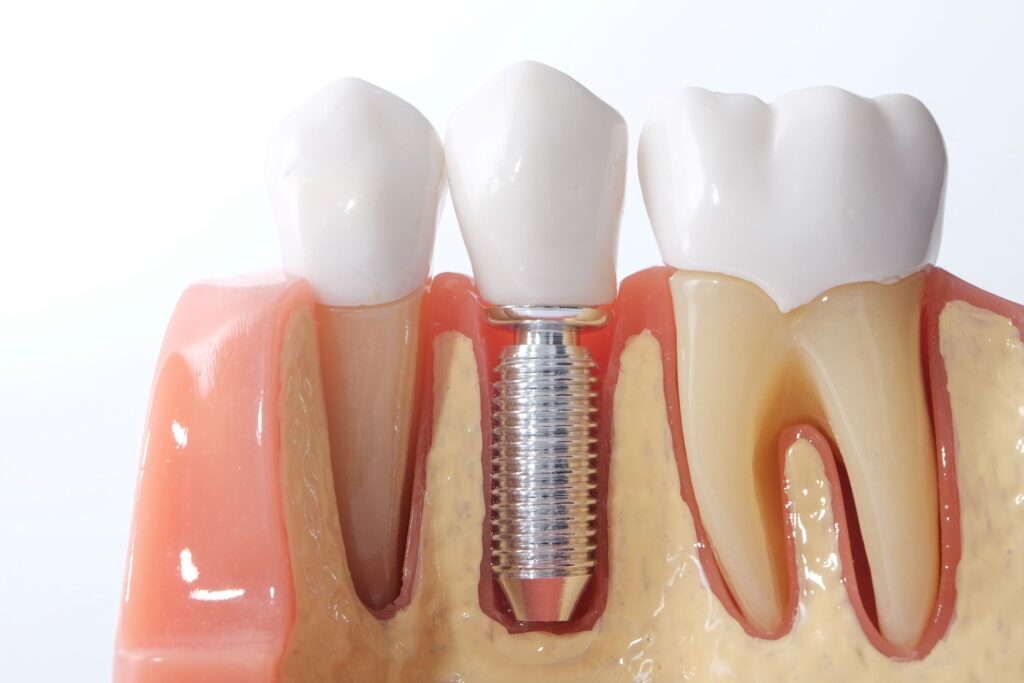 Model dental implant between two other fake teeth in a shiny model jaw